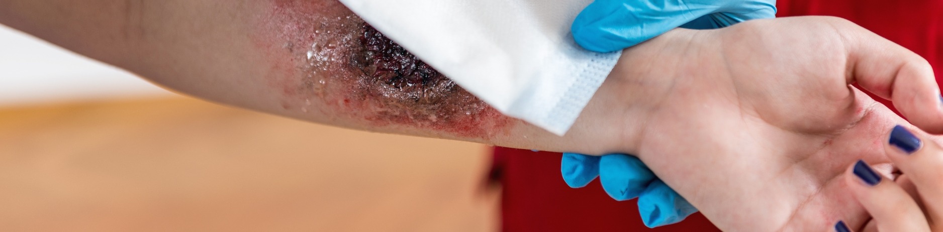Graphic close-up of arm in burn injury case being treated by doctor's gloved hand