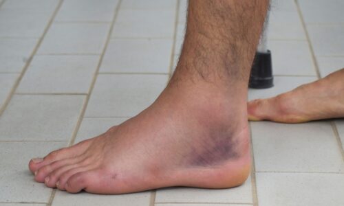 sprain from a car accident